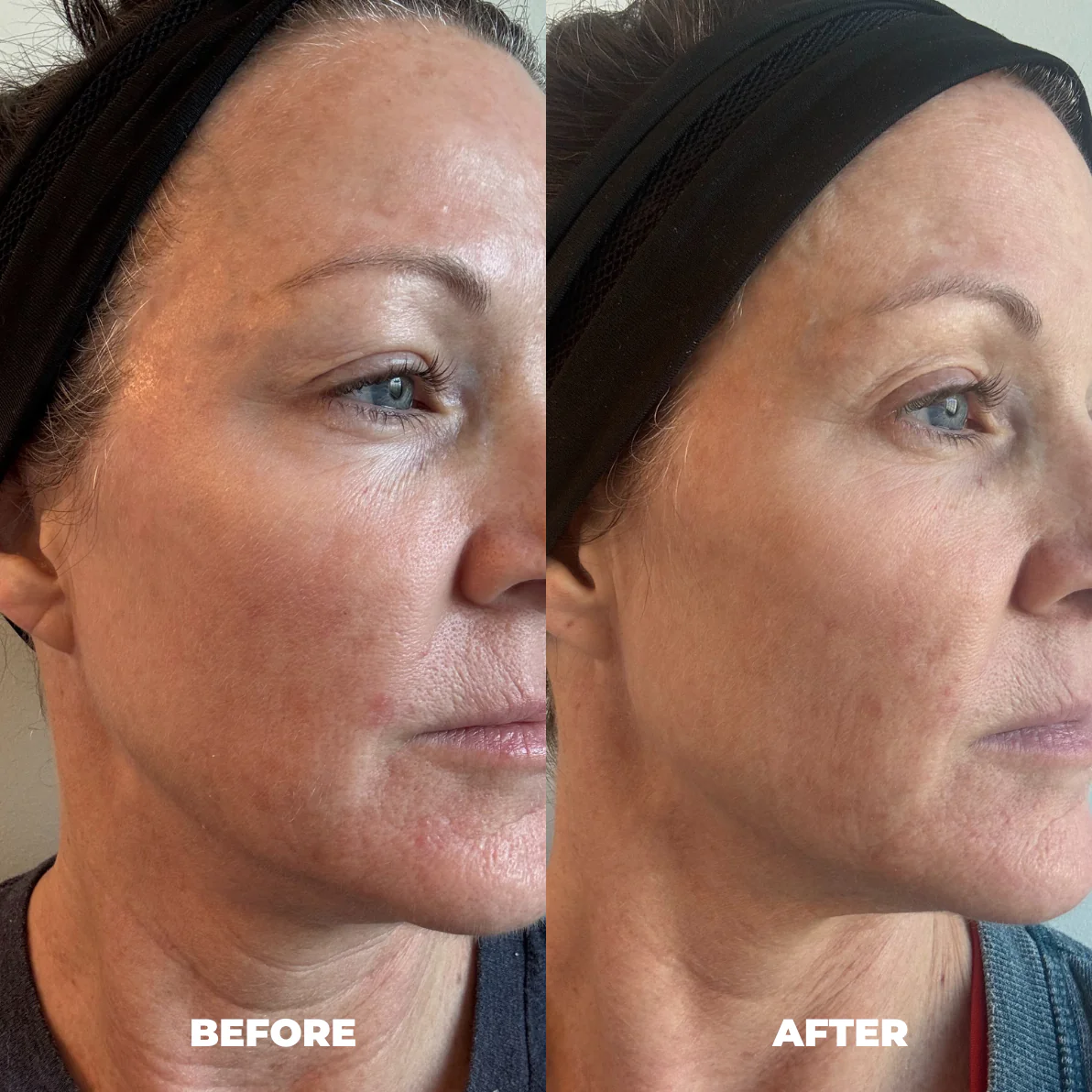 Anna T. — RoyalGLOW Mask before and after
