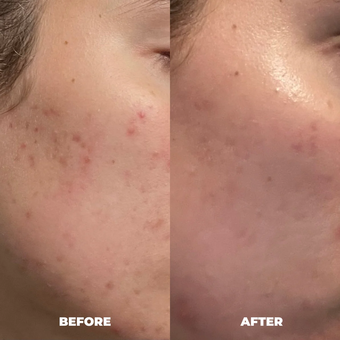 Ashleigh A. — RoyalGLOW Mask before and after