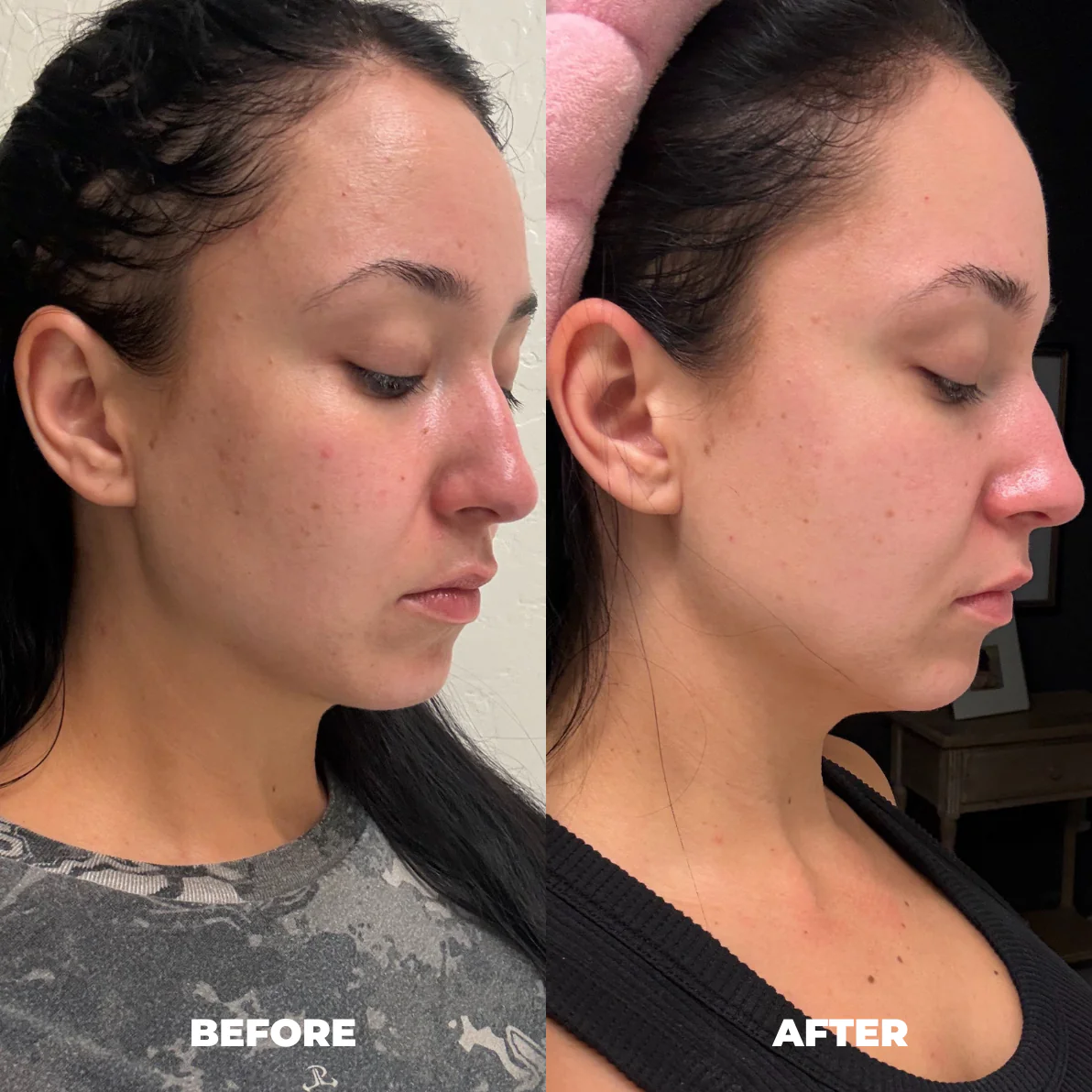 Talia S. — RoyalGLOW Mask before and after