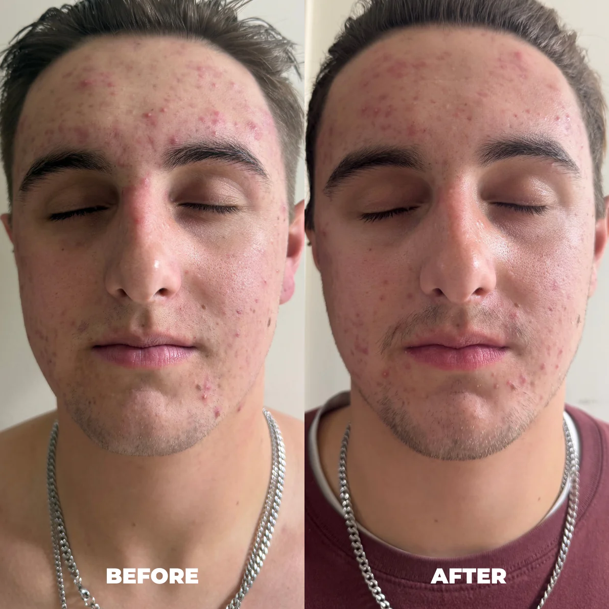 Wes M. — RoyalGLOW Mask before and after